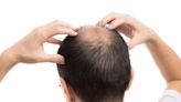 植髮4年後「頭頂又稀疏」 醫曝問題關鍵：還是要生髮