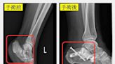 女騎車自摔「腳扭曲變形」險休克⋯醫揭「腳跟骨骨折」併發症超多