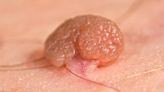 Skin Tags Linked to Metabolic Syndrome in Children