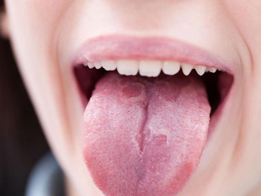 ¿Cómo saber si tengo alguna enfermedad en mi lengua?