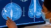 Brustkrebs-Früherkennung künftig bis 75 Jahre