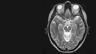 New Test Predicts Future Cognitive Decline in Alzheimer's Disease