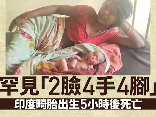 印度婦誕畸胎「2臉4手4腳」 出生僅5小時死亡原因慘痛