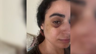 “‘Perdí muchas capas de piel’: Mujer es atacada por un extraño mientras caminaba con su perro en Fairfax