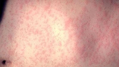 Global measles cases nearly doubled in one year, researchers say