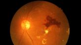 What to Know About Diabetic Retinopathy