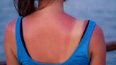 How to soothe painful sunburn