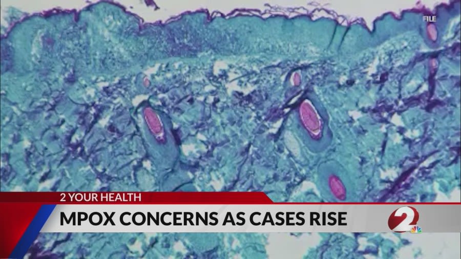 CDC, WHO monitoring overseas outbreak of M-Pox: What we know