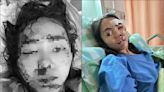 立院外抗議遭網攻 「輪椅女孩」PO傷勢照反擊