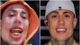 Quanto custa a prótese de ouro que MC Daniel colocou nos dentes?