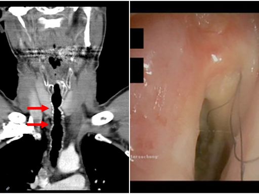 Austrian man grows hair inside throat after smoking for over 30 years; know all about the rare condition