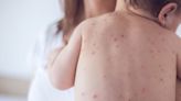 Measles case confirmed as experts fear UK faces worst outbreak in 12 years