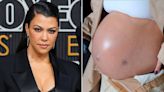 Pregnant Kourtney Kardashian Shows Scar from Fetal Surgery During Maternity Photo Shoot: 'Fragile Little Egg'