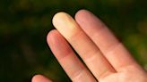 Study pinpoints genes behind Raynaud’s phenomenon, which could lead to better treatments