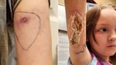 Girl, 9, Thinks Shirt Tag Pinched Her. Then Mom Discovers Brown Recluse Spider Bite That Quickly Spread