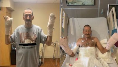 Florida man who lost most of his fingers in fireworks explosion opens up about life-changing accident