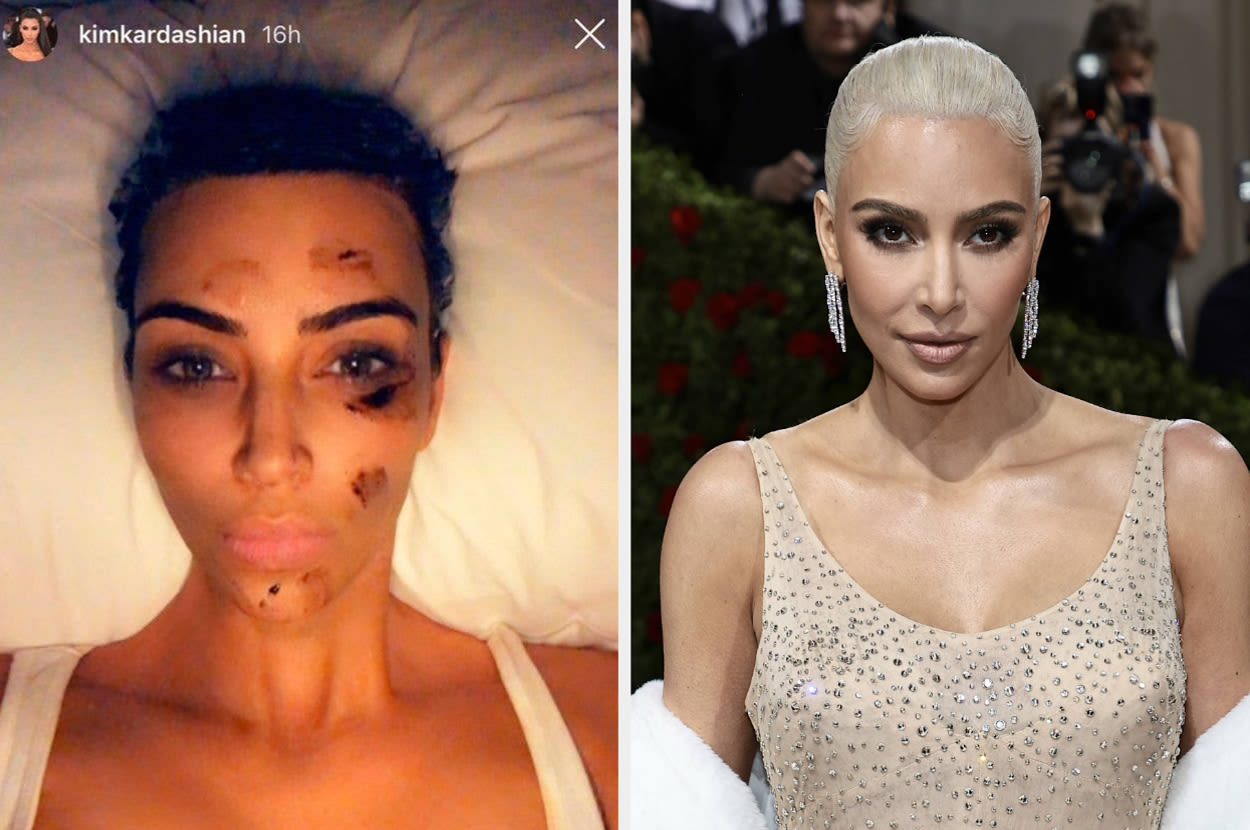 Kim Kardashian Opened Up About Her Psoriasis Flare-Up That Nearly Ruined Her Met Gala Appearance