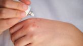 Hand Rash: 12 Possible Causes and Treatment Options