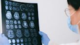 Maladie d’Alzheimer : pourquoi l’Agence européenne du médicament a bloqué la mise sur le marché de ce nouveau traitement ?
