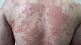 Dealing With Psoriasis on Your Back