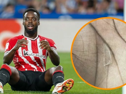 Iñaki Williams ha jugado dos años con un cristal en la planta de un pie