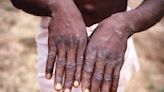 As monkeypox outbreak grows, experts offer early ideas about why it's spreading