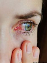 Pink Eye: Types, Causes, Symptoms, Treatment & Prevention - My Health Only