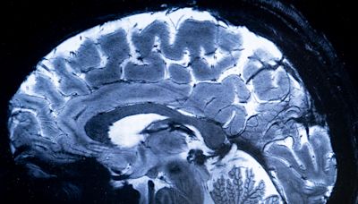 Dementia breakthrough "vital" for future treatment: Scientists