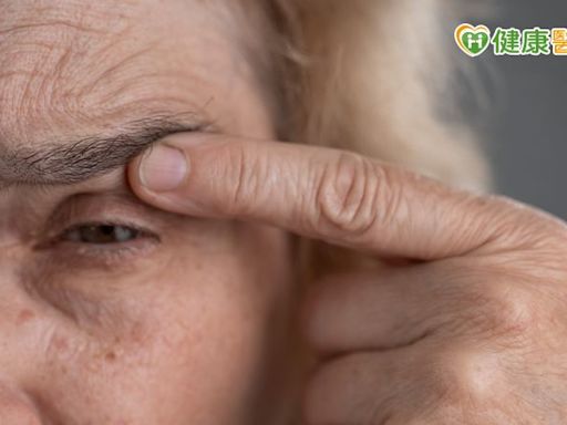 眼睛閉合不全害眼角膜潰瘍 她在「眼瞼內埋黃金」改善多年乾眼症