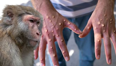 La viruela del mono no tiene cura y suma más de 30 contagios en Perú: signos de alerta y quiénes están en peligro