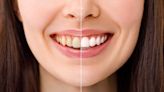 Best Teeth Whitening Kits 2024 by Dentists