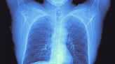 This Simple Change Could Help Diagnose Millions More Cases of Lung Disease