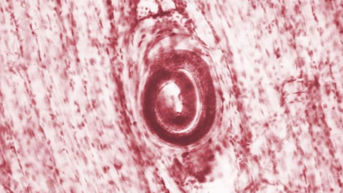 Parasitic worms infect 6 after bear meat served at family reunion