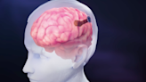 Neuralink rival shatters record, implants 4,096 electrodes in brain
