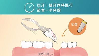 快速植牙不再等待 即拔即植技術大解析