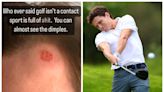 Tom Holland, astro de 'Homem-Aranha', mostra machucado após golfe com a família: 'Esporte de contato'