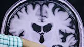 Ser otimista pode ser uma forma de proteção contra o Alzheimer