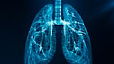 Lung Cancer Screening Can Catch Tumors When They're Curable, New Research Finds