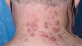Study Elucidates Skin Signs of VEXAS Syndrome