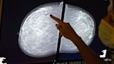 Black patients may need breast cancer screenings earlier than what many guidelines recommend