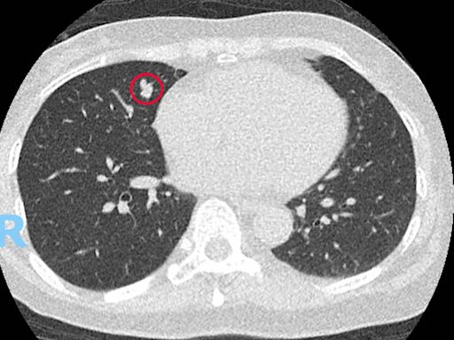 婦肺癌篩檢發現0.9公分小結節 一驗竟是「類癌」 - 自由健康網
