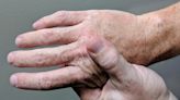 Guillain-Barré syndrome risk greater after COVID-19, study indicates