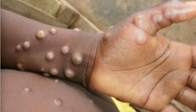 32歲長期病患男子染猴痘 曾訪內地在港有高風險接觸 | am730