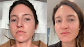 This Chemical Peel *Majorly* Healed My Hormonal Acne