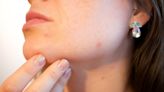 Acne improves with omega-3 fatty acids, plant-based diet, study shows