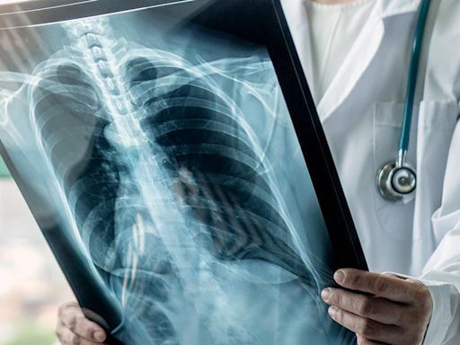 AI-based lung cancer screening in Karnataka detects 133 lung nodule malignancy and nearly 3,000 TB-presumptive cases in last nine months