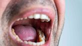 8 Causes of a Bump on the Roof of the Mouth