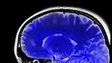 Brain imaging study reveals connections critical to human consciousness