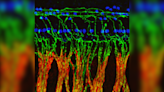 Tinnitus may stem from nerve damage not detectable on hearing tests