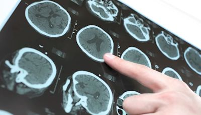 El COVID-19 puede aumentar el riesgo de padecer Alzheimer, Parkinson y ACV, según un estudio